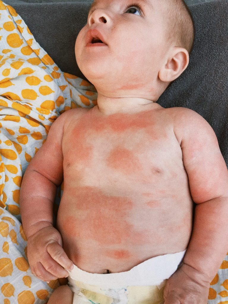 mamablog baby allergie onder mama's